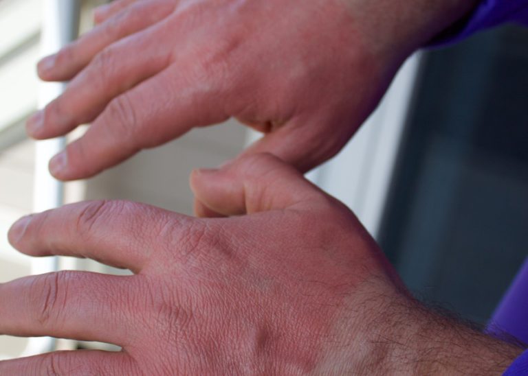 Solar Uticaria is just one of the reasons we switched to a whole-foods, plant-based diet